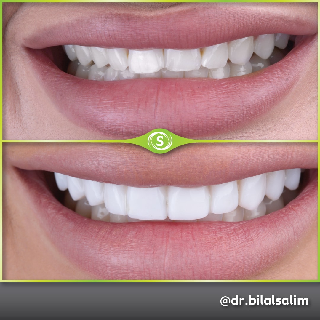 Composite Bonding - Dr. Bilal Salim