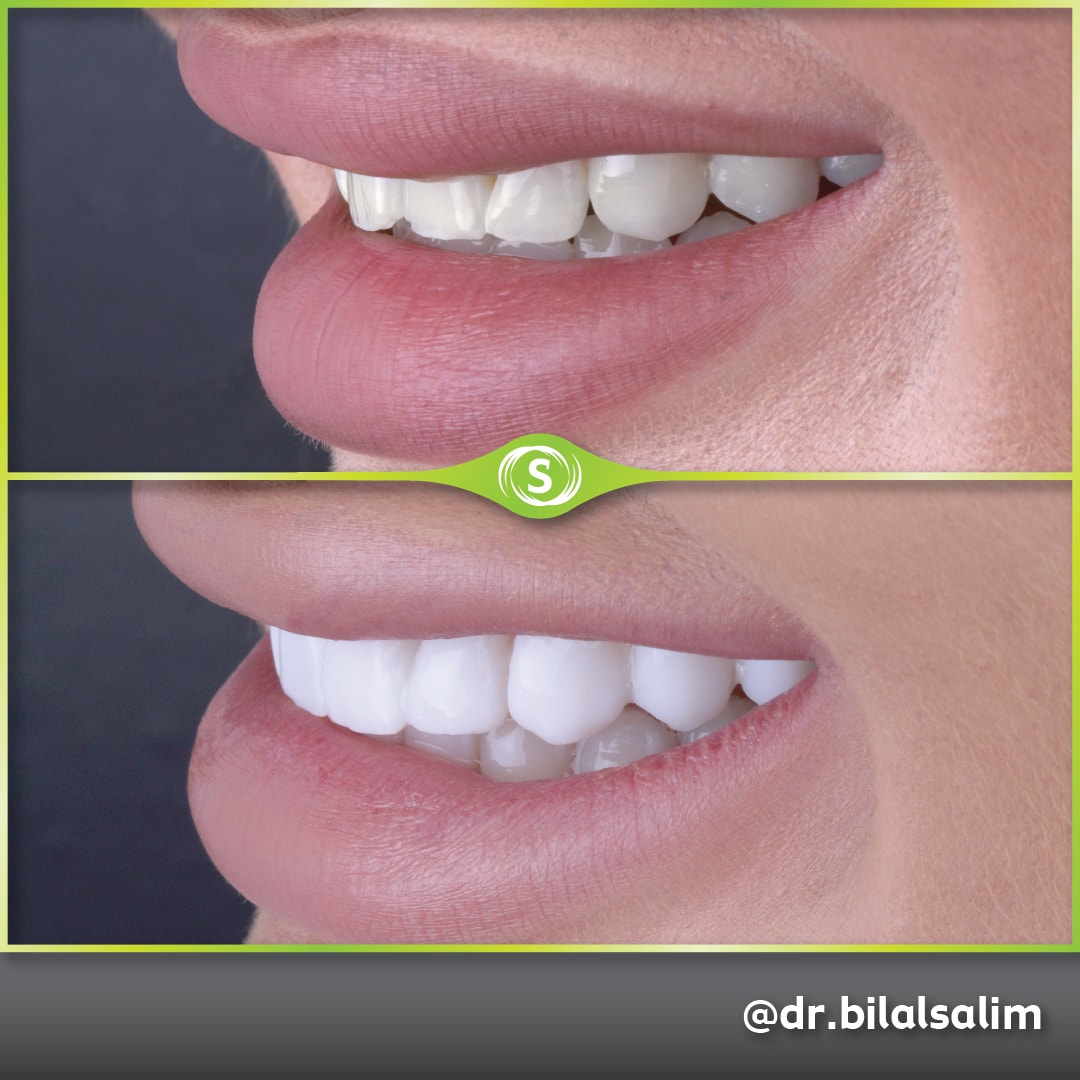 Composite Bonding - Dr. Bilal Salim