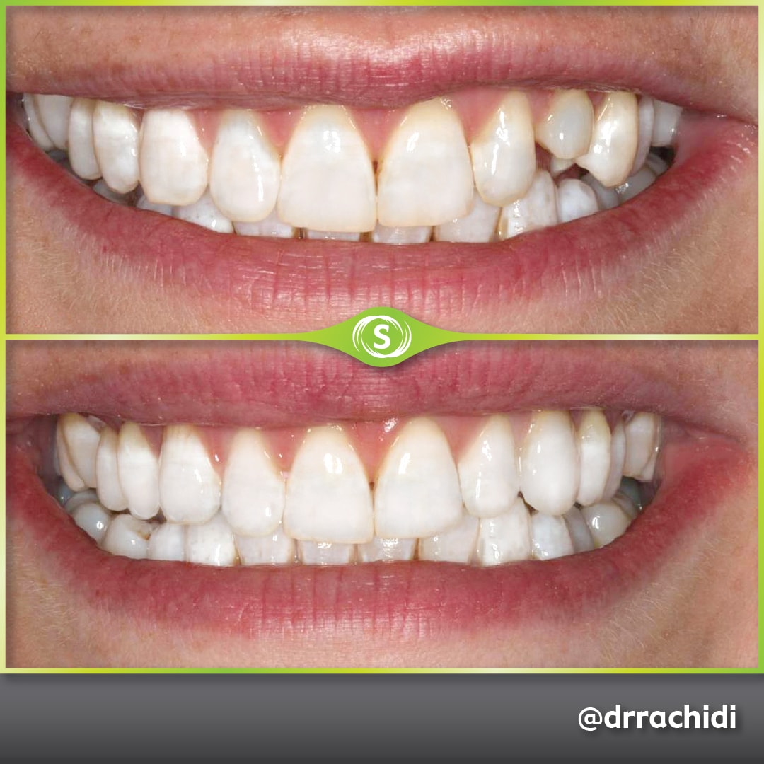 Dental Crowns Zirconia - Dr. Karim Rachidi