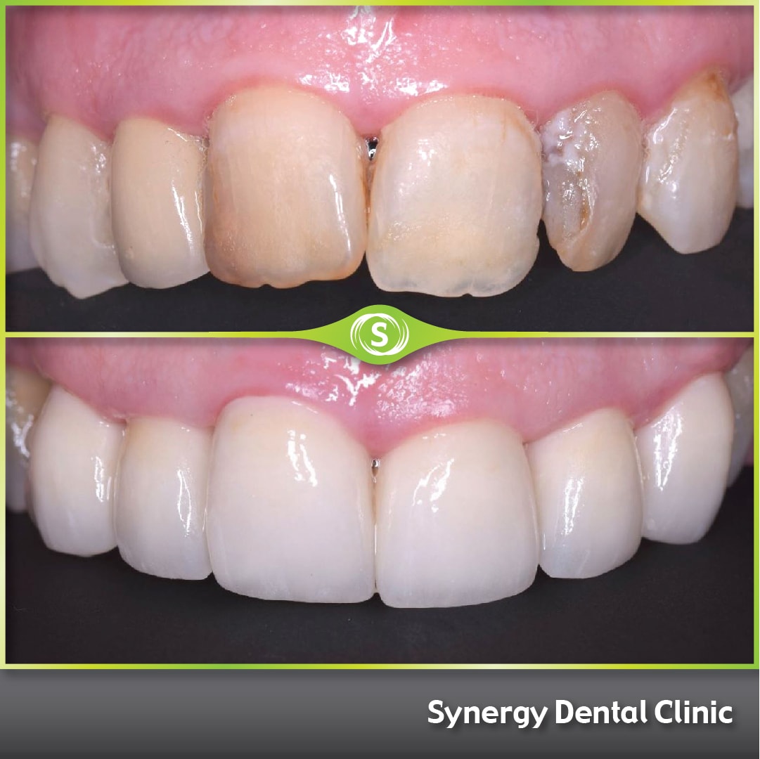 Composite Bonding Case 444