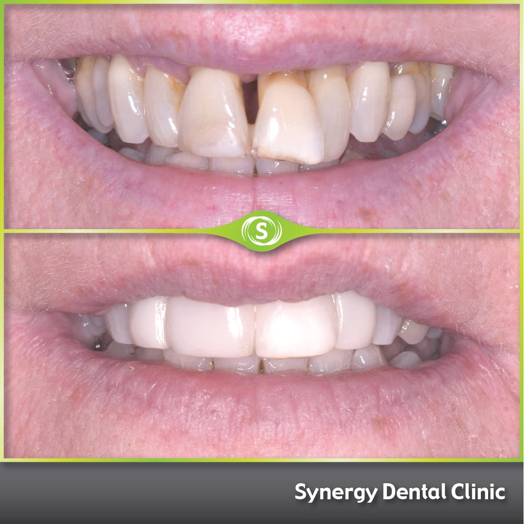 B&A Whitening and Bonding SDC 1-min