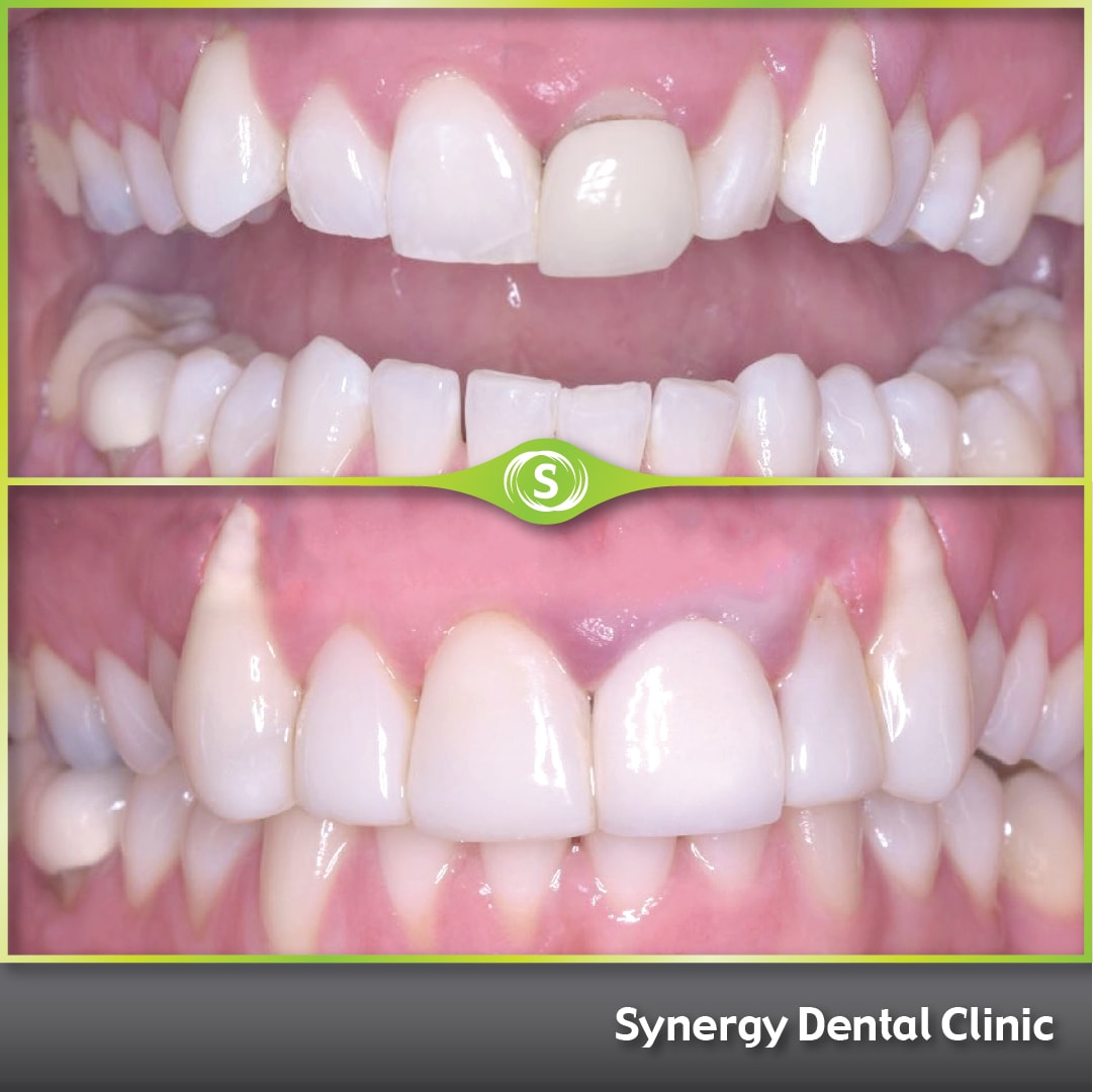 B&A Whitening and Bonding SDC 2c-min