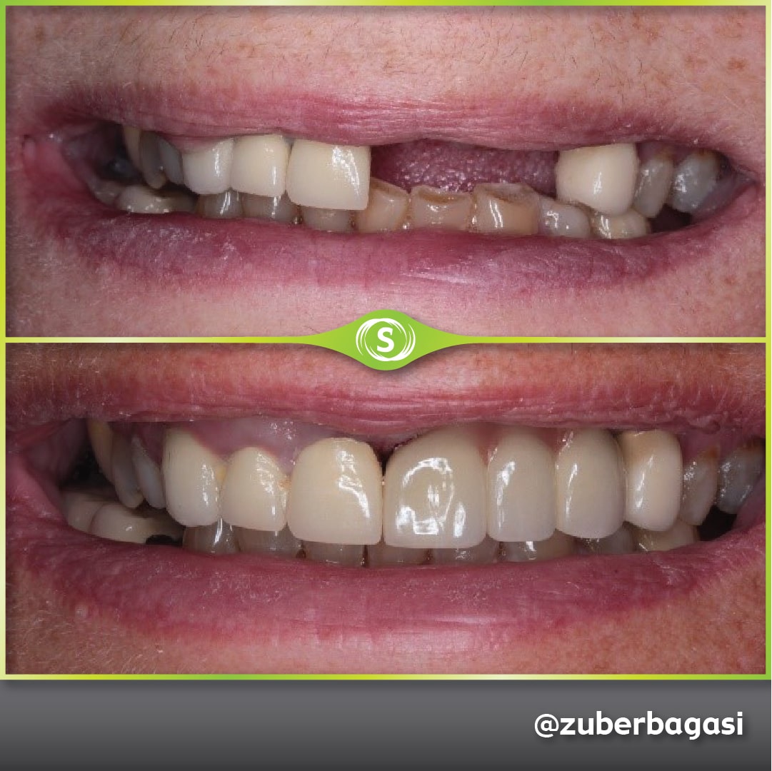 B&A Dental Implants - 3 Unit Bridge