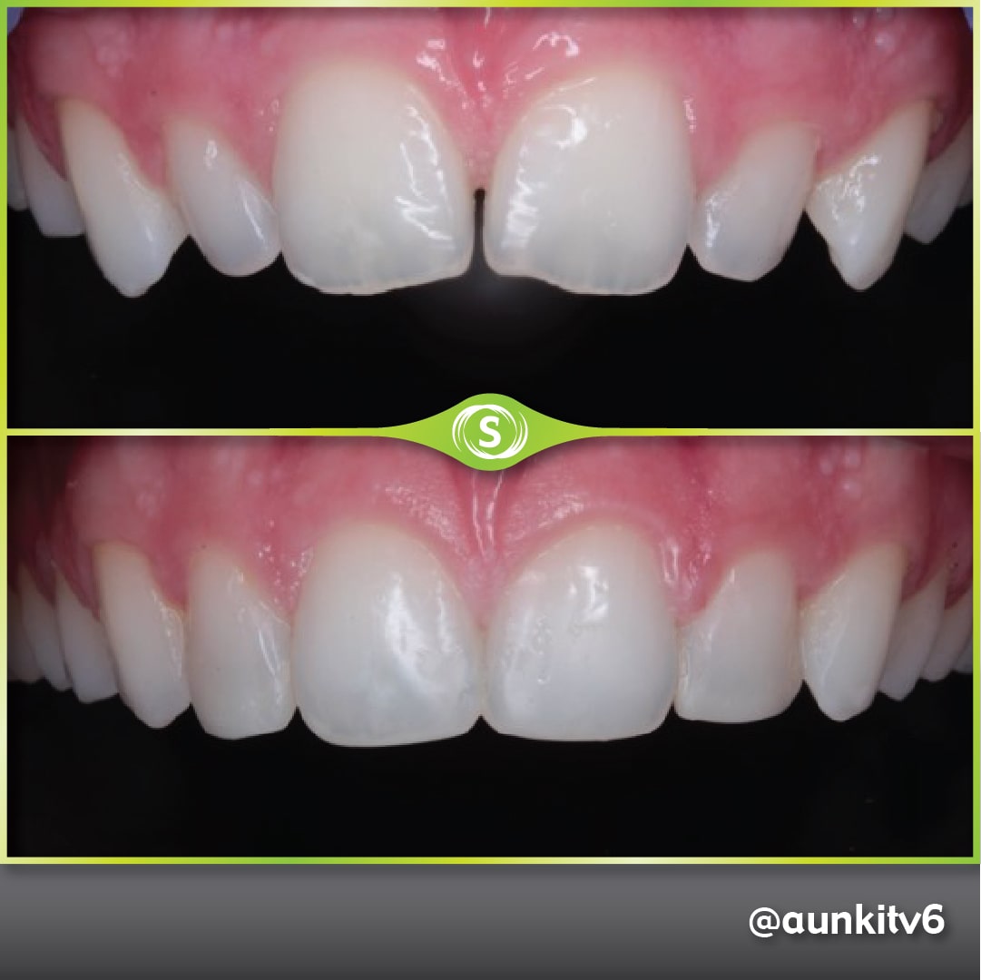 B&A Invisalign AV 3c-min