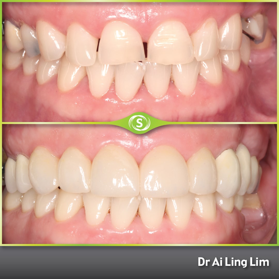 B&A Veneer Bridges KM AL 1-min