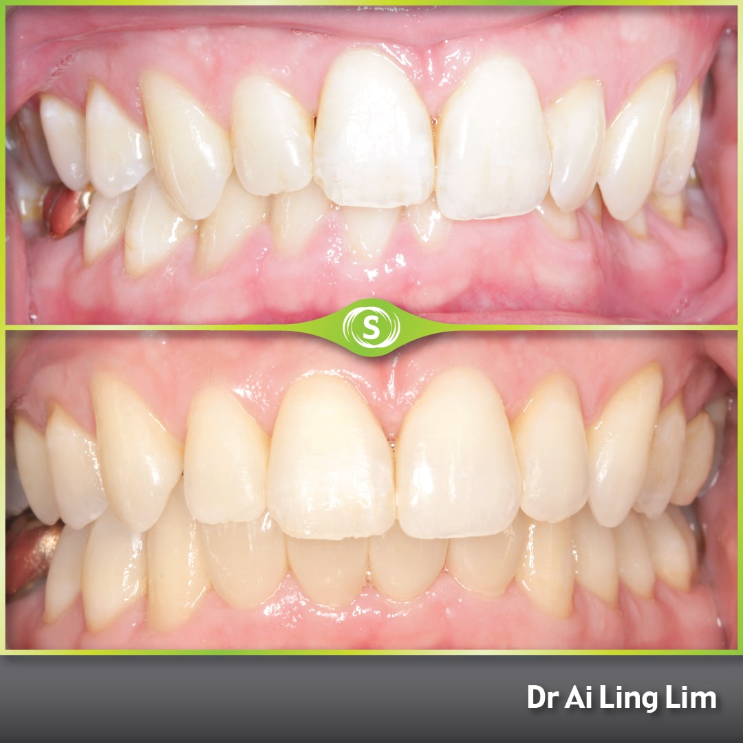B&A Veneers Invisalign AL 2-min