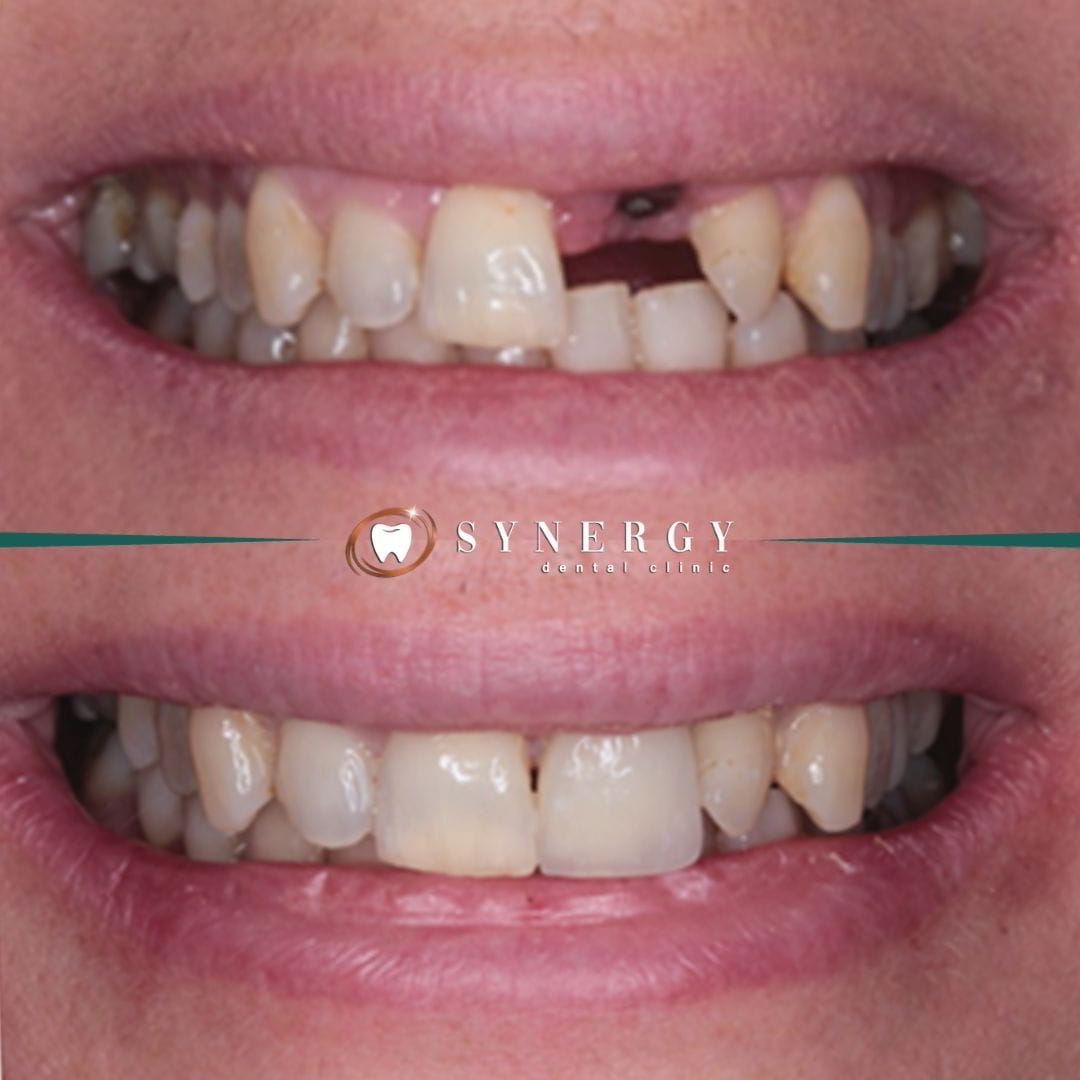 Dr. Zuber Bagasi - Synergy Blackpool - Single implant