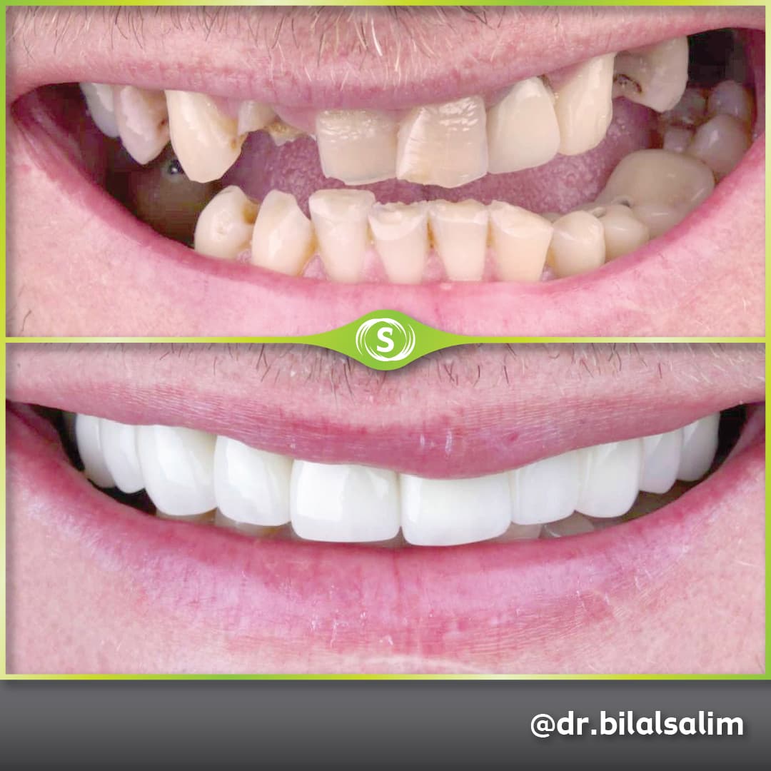 B&A Crowns and Bridges BS-min