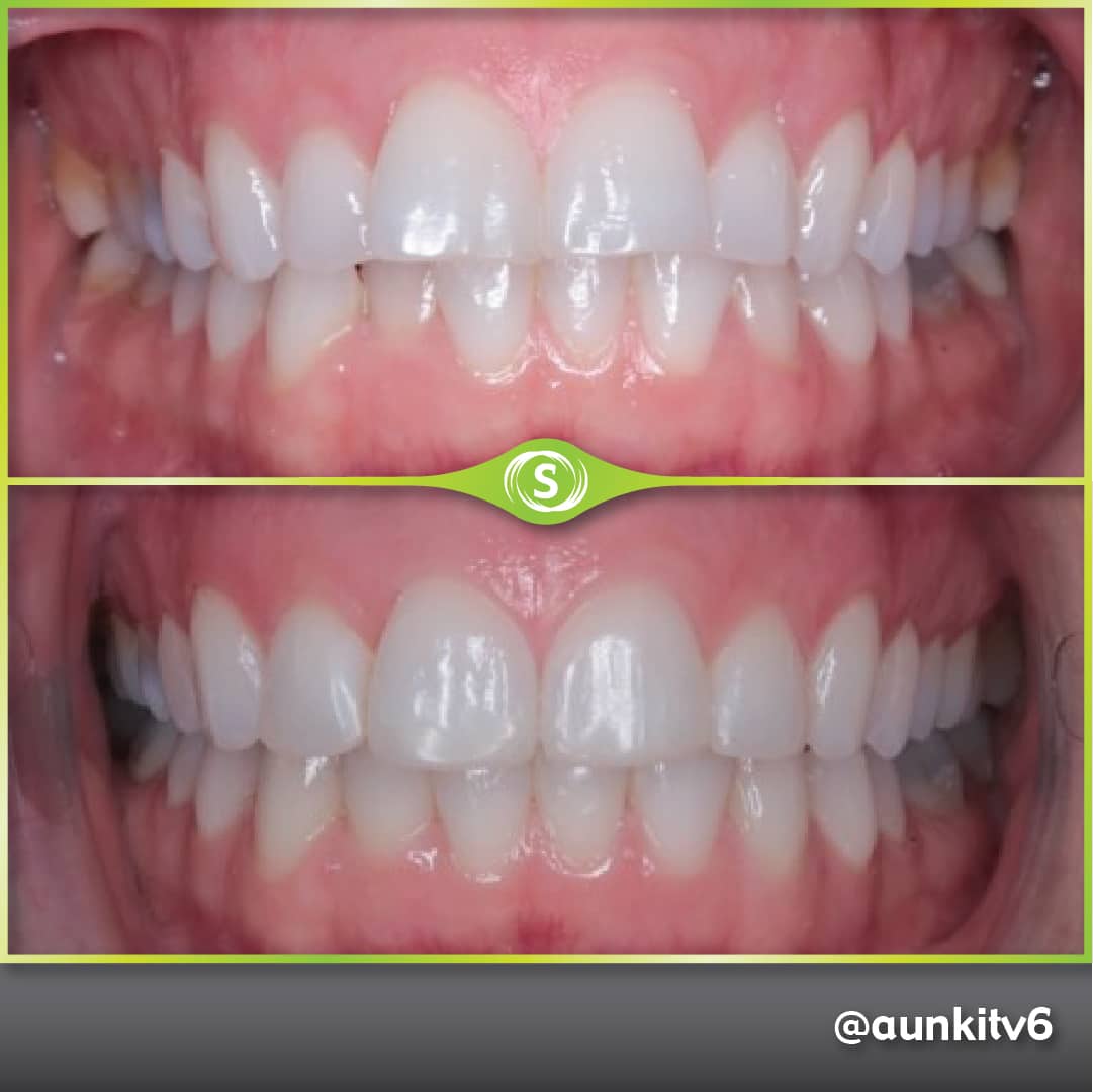 B&A Invisalign AV 5a-min