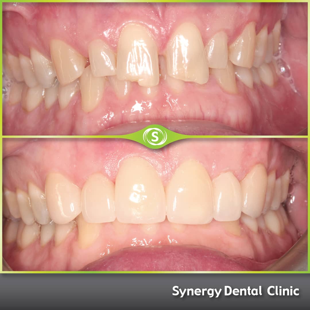 B&A Veneer AL 1-min