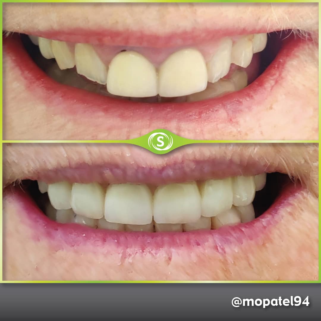 B&A Zirconia Crowns MP 1-min (1)