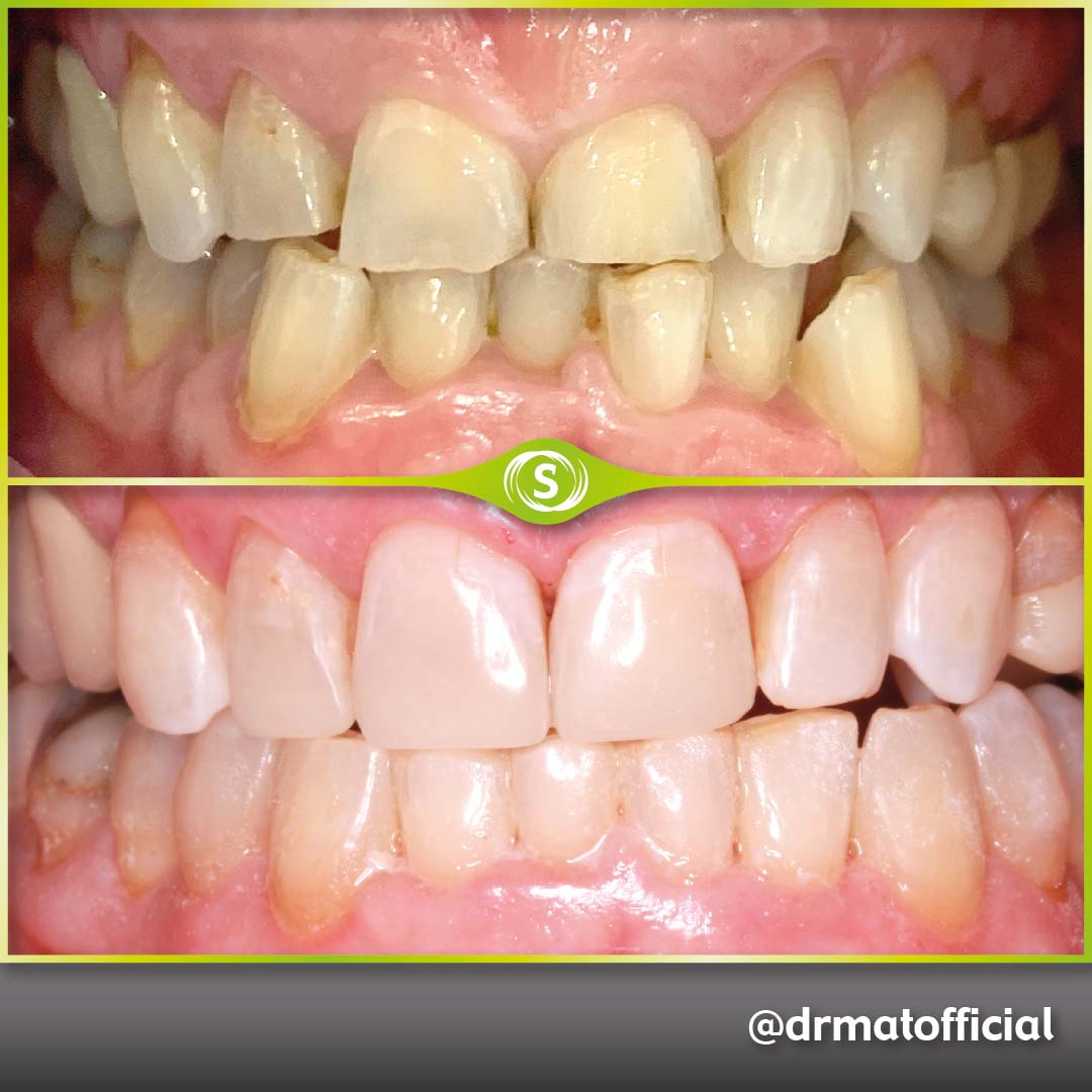 Invisalign and Composite bonding