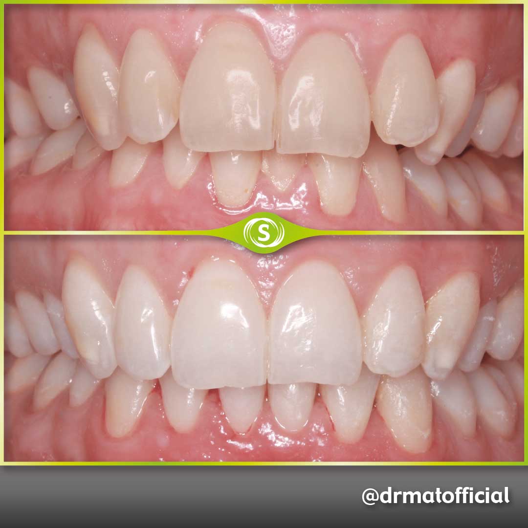 Invisalign and Composite bonding