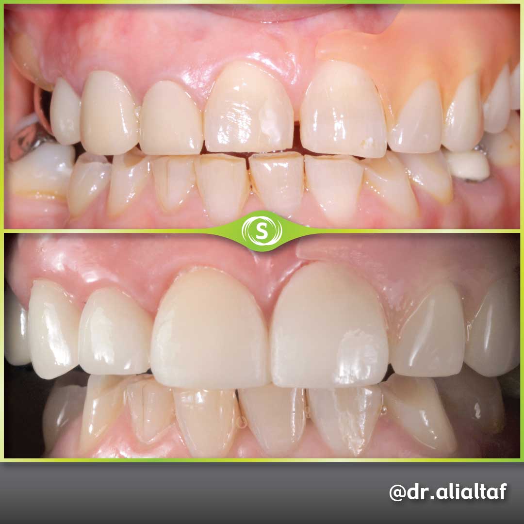 Emax Veneers