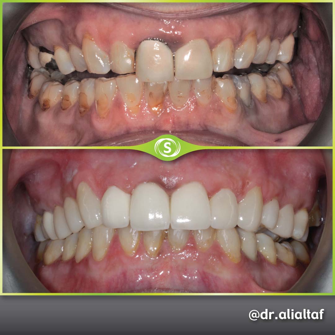 Composite veneers