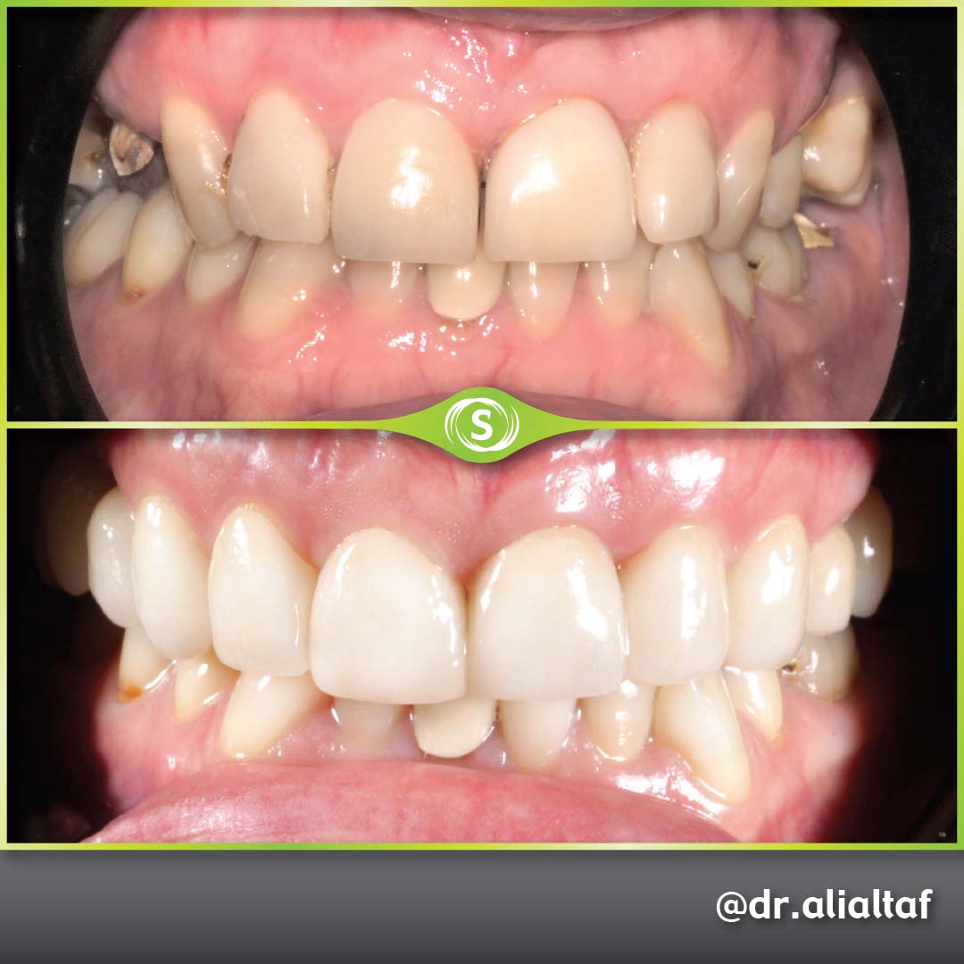 Veneers
