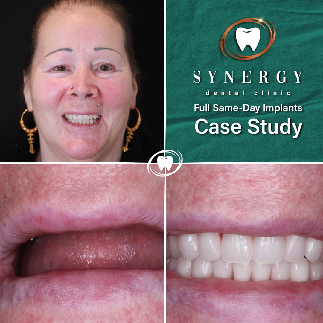 same day implants case study