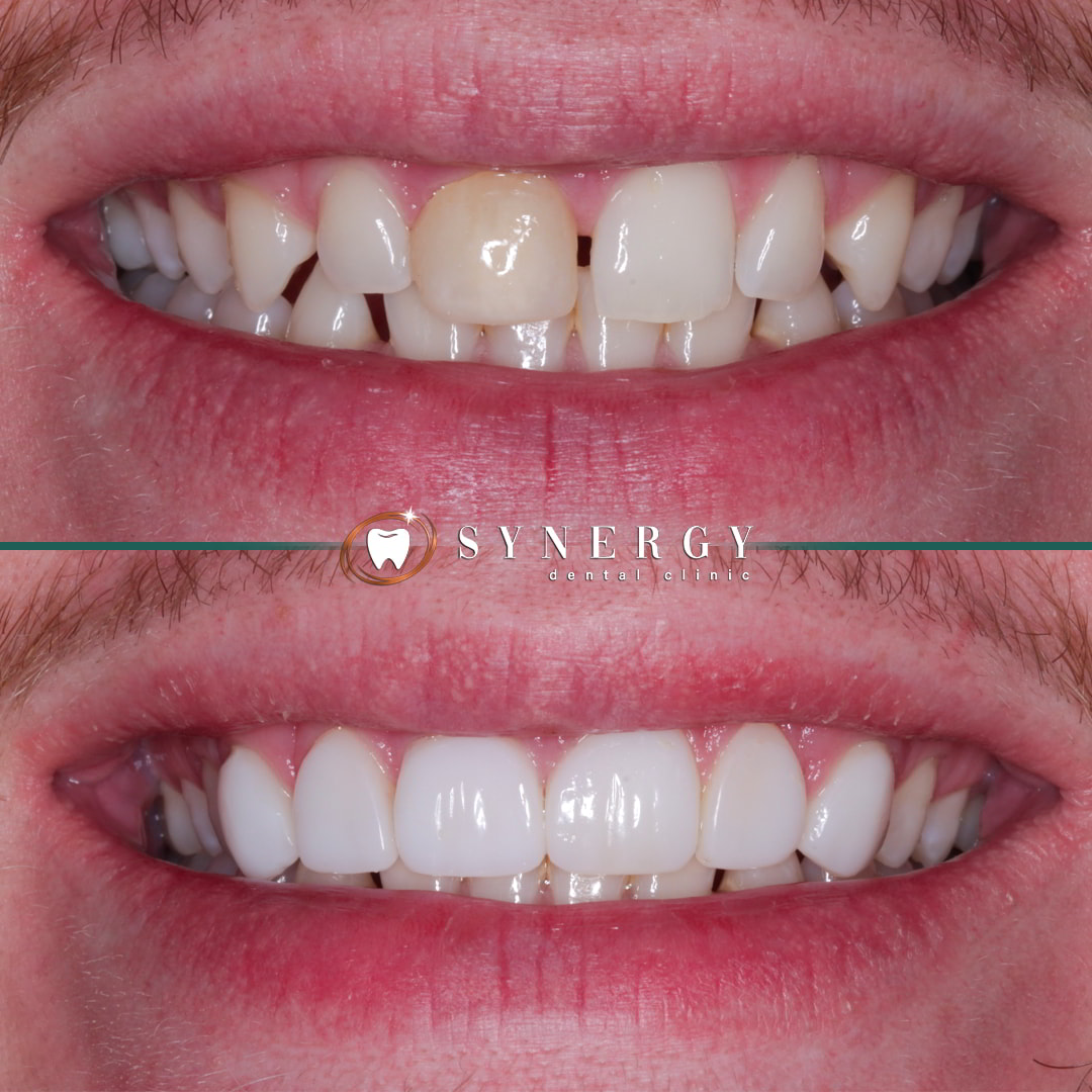 Dr. Mateen Ahmed - Synergy Chorley - Composite bonding 8763