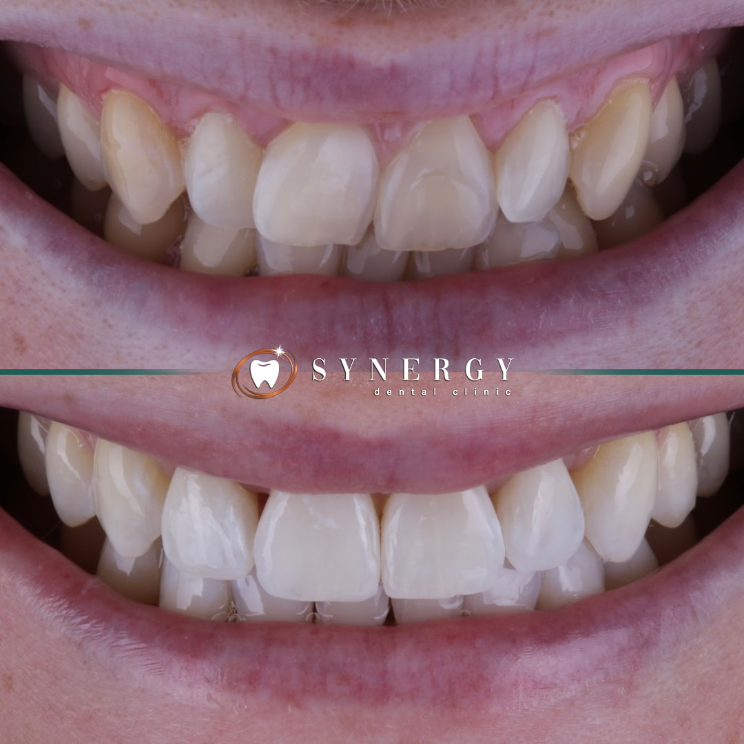 Dr. Mo Patel - Synergy Bolton - Invisalign12