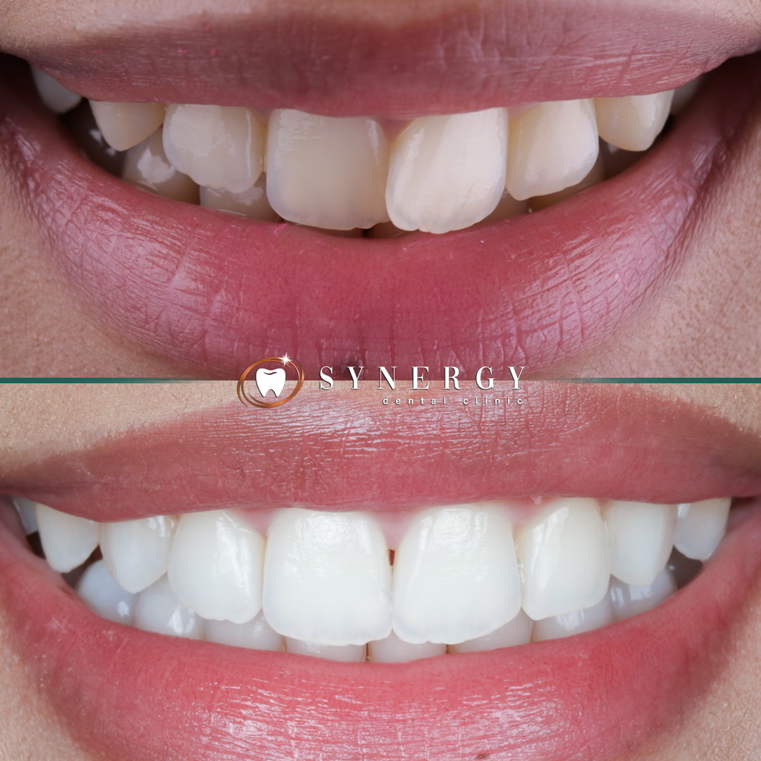 Dr. Mo Patel - Synergy Bolton - Invisalign