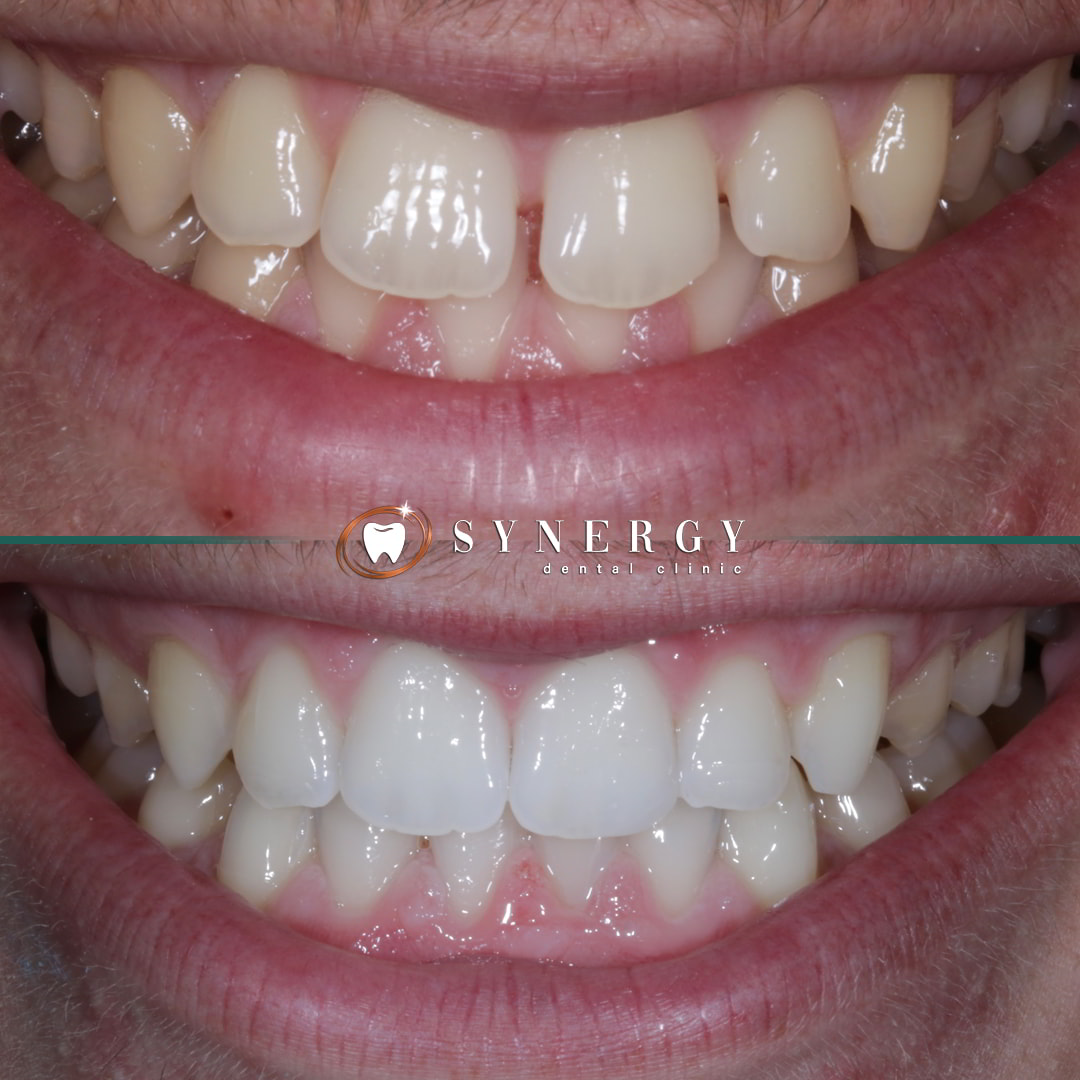 Dr. Mo Patel - Synergy Bolton - Invisalign