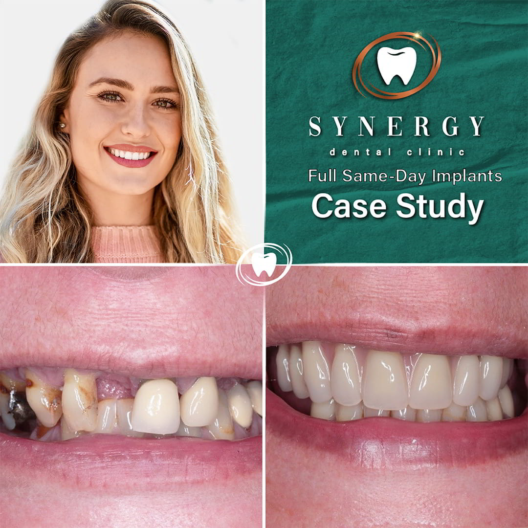 Dr. Zuber Bagasi - Synergy Blackpool - Same day implants