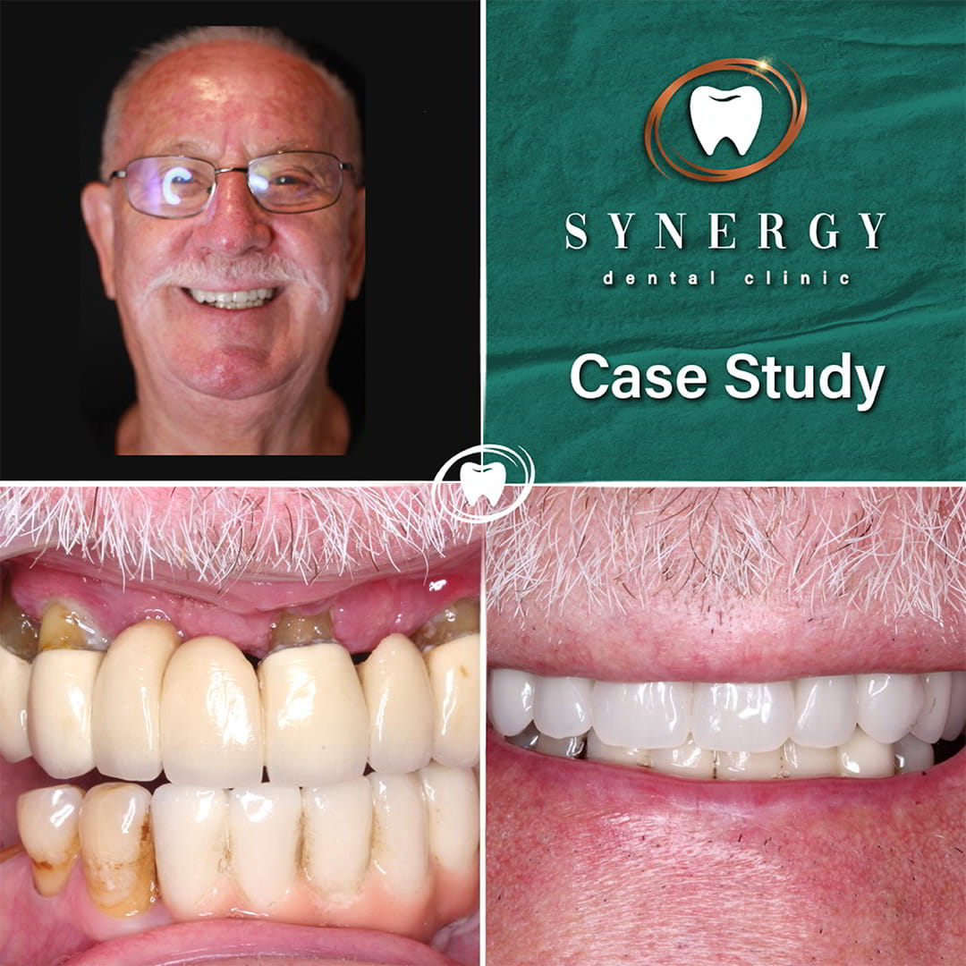 Dr. Zuber Bagasi - Synergy Blackpool - Same day implants