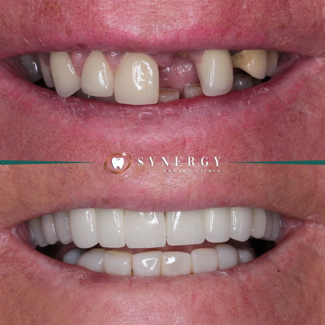 Dr. Zuber Bagasi - Synergy Blackpool - Single implant