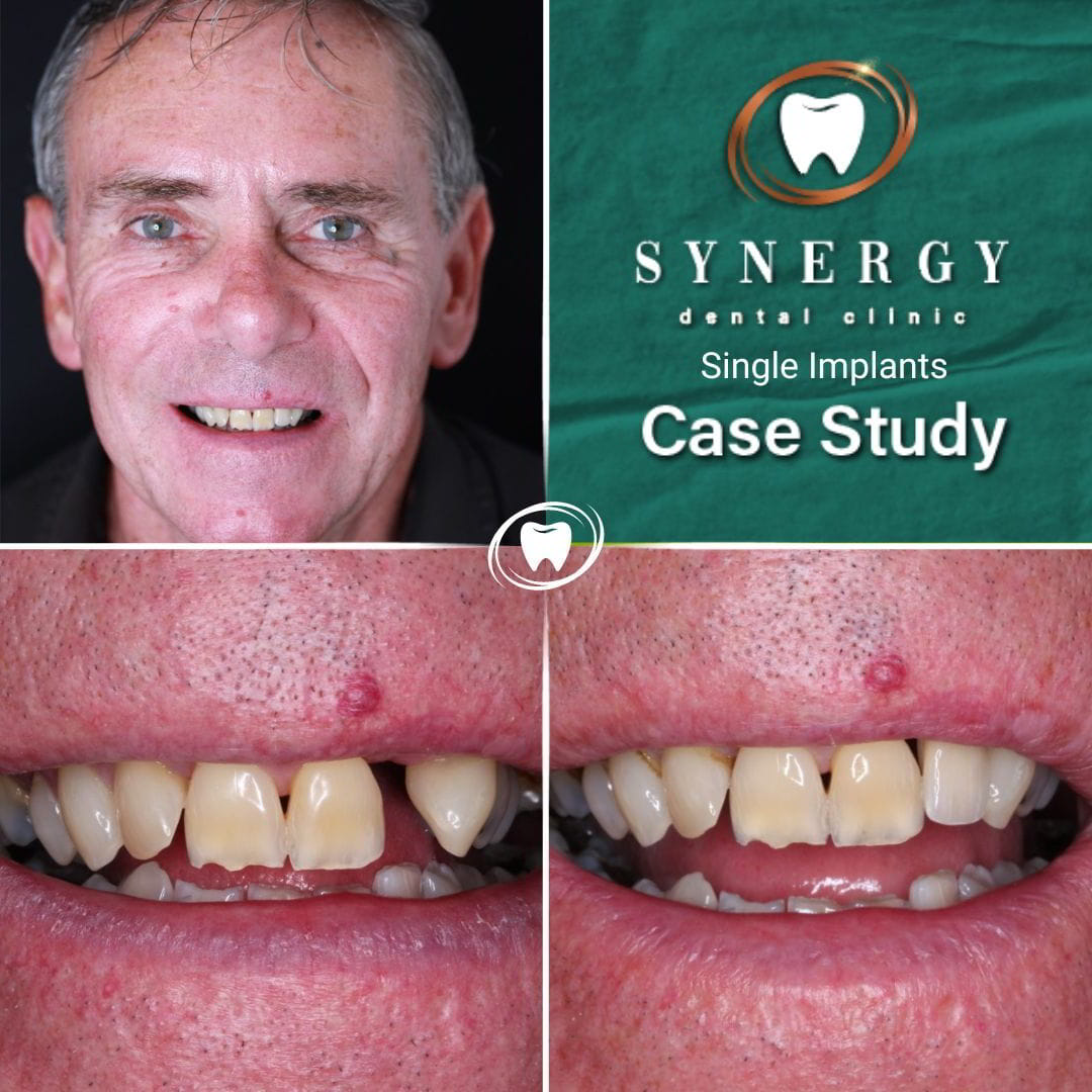 Dr. Zuber Bagasi - Synergy Blackpool - Single implant