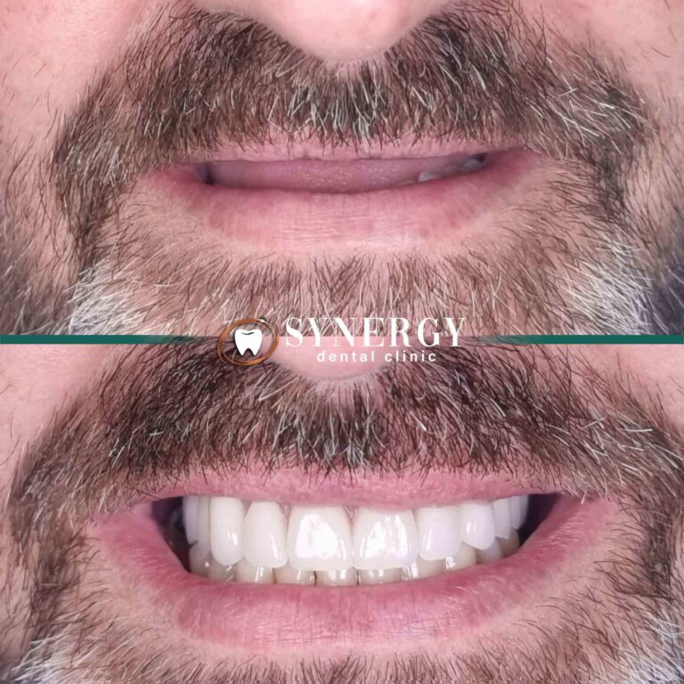 Full Arch implant