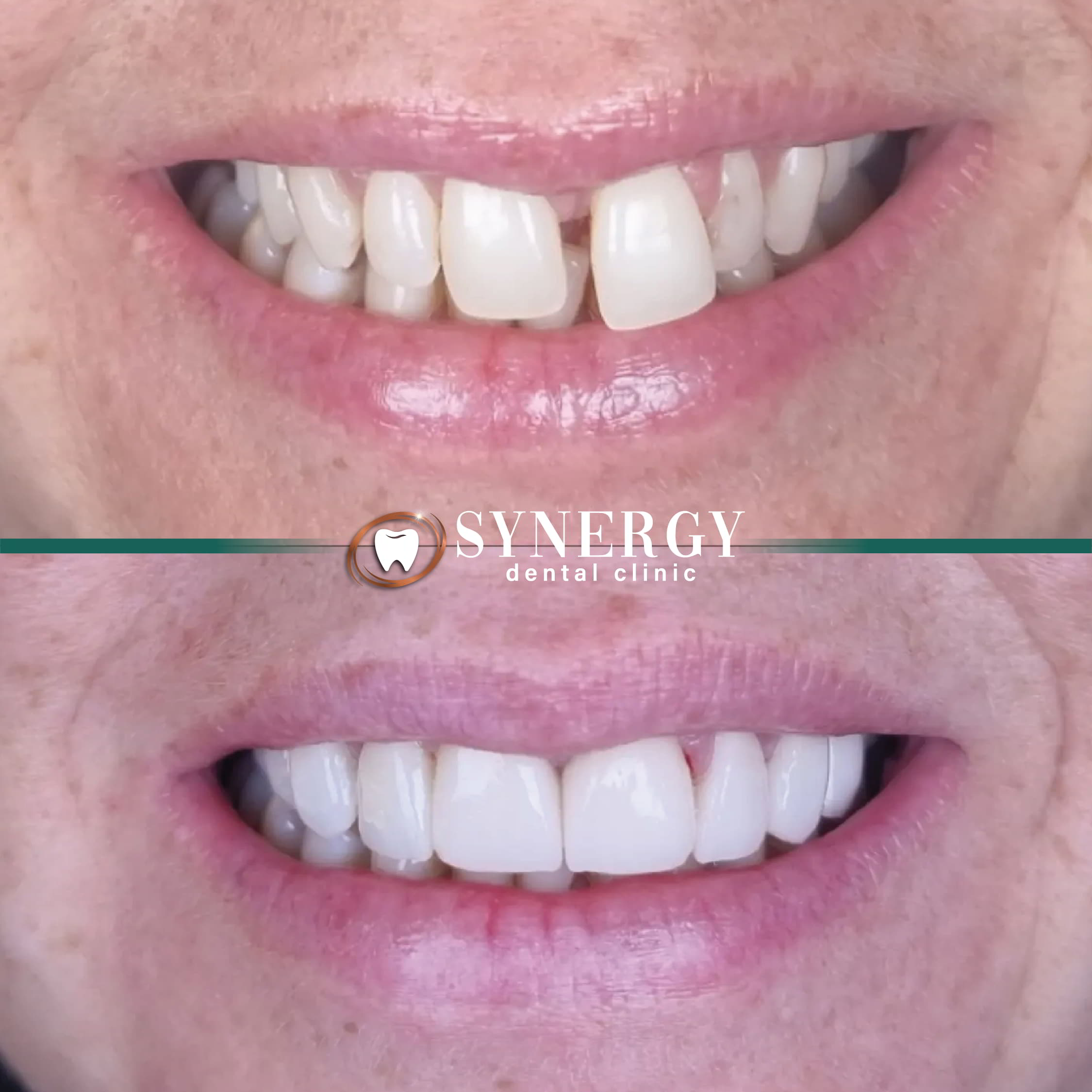 Dr. Karim Rachidi composite Veneers 2-01